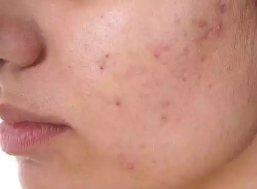 Facial Soap for Acne-Prone Skin